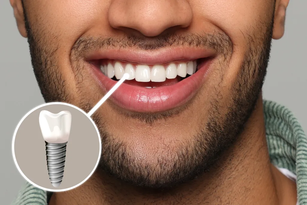 Dental implant restoration at Indian Trace Dental